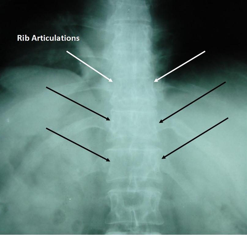 thoracic ribs and articulations